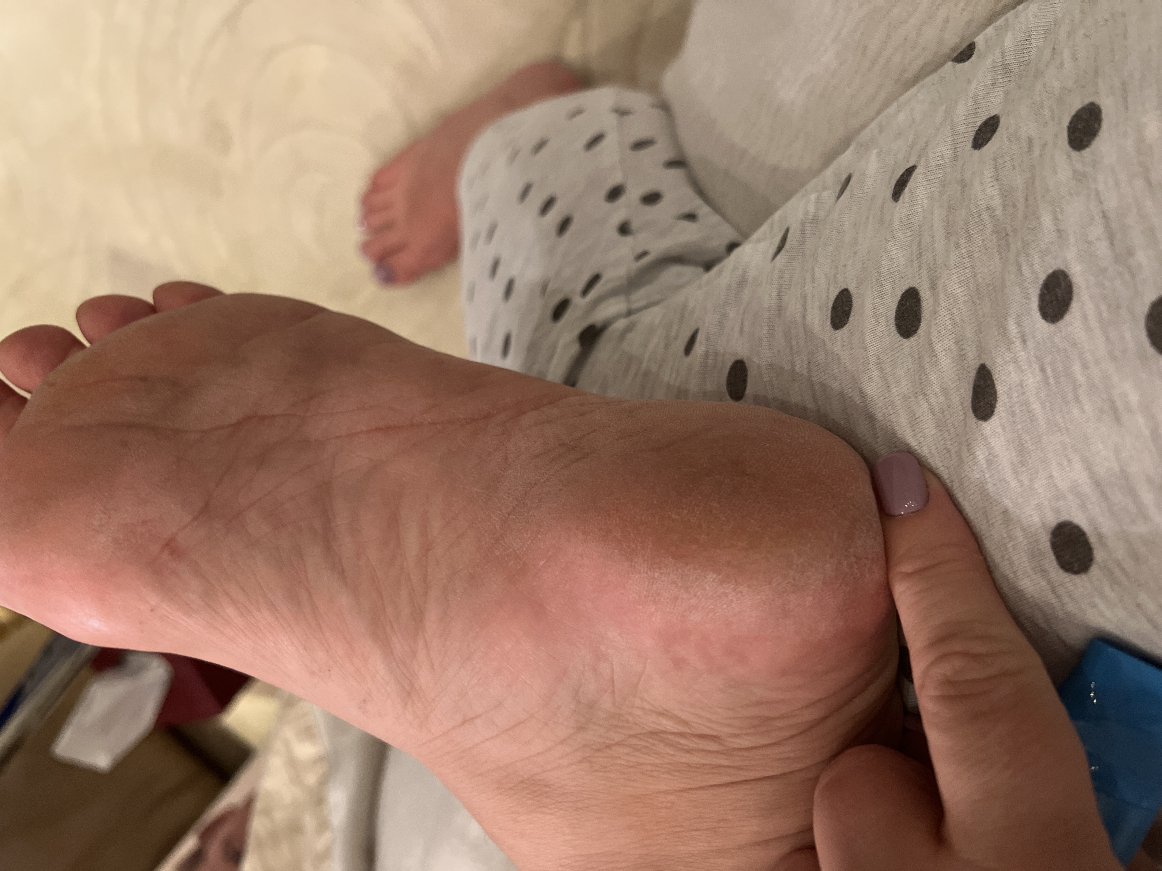 Pritech's $19 Electric Callus Remover 'Works Wonders' on Dry Feet